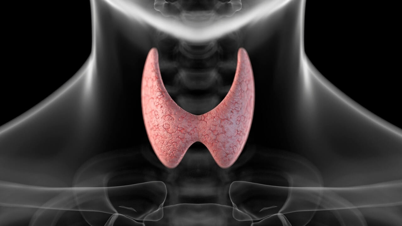 Tiroidite di Hashimoto autoimmune Vitiligine
